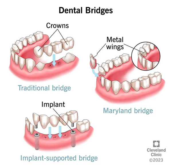 dental bridge