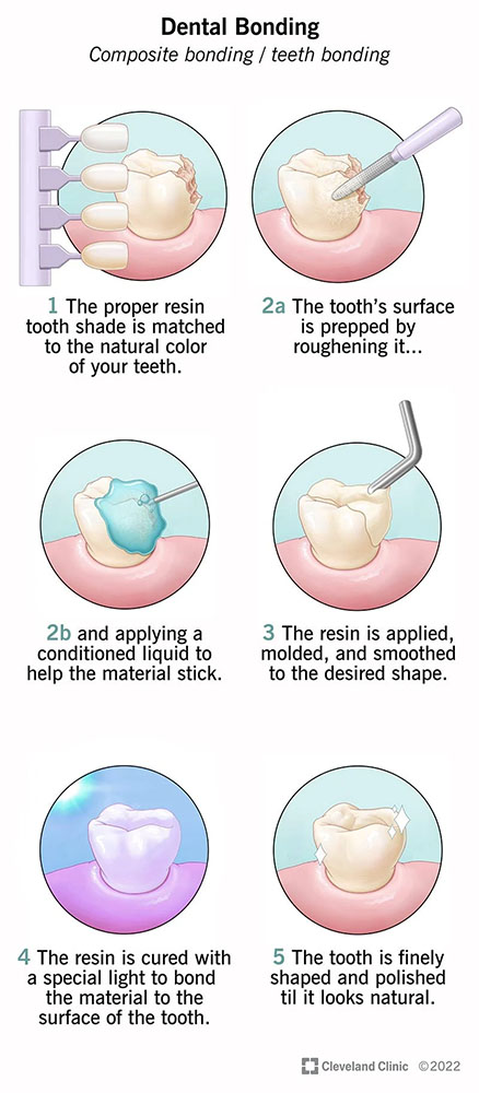 dental bonding graphic