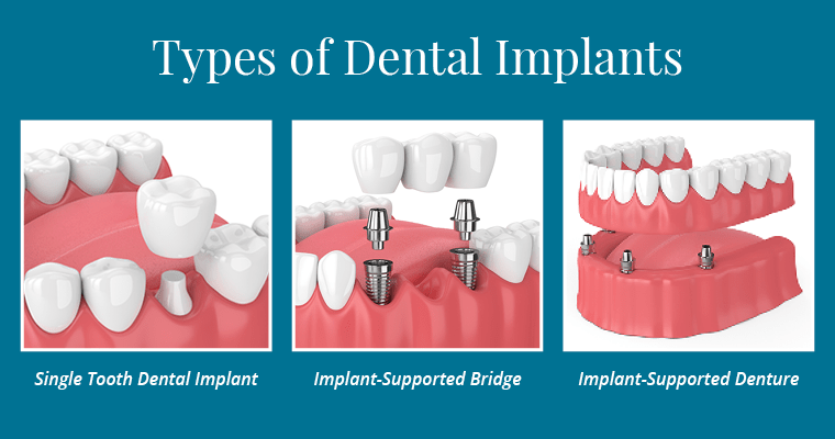 Types of dental implants